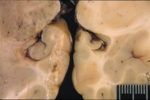 A photo showing the right and left hippocampus in a sea lion brain. The right hippocampus (the U-shaped parts in the middle) is significantly smaller than the left. Image courtesy of The Marine Mammal Center, Sausalito